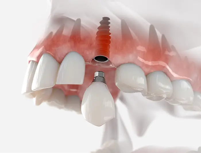 dental implants