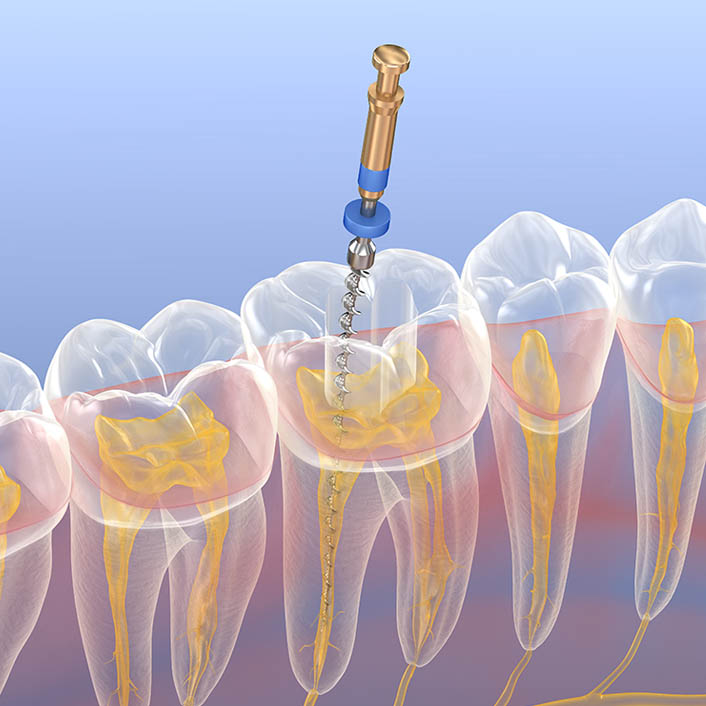 Root Canals